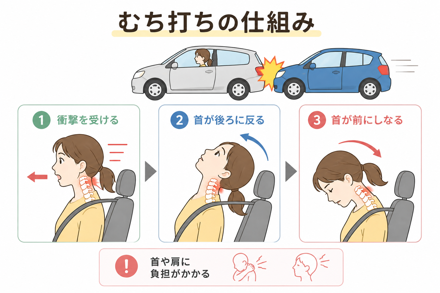 交通事故によるむち打ちの仕組み