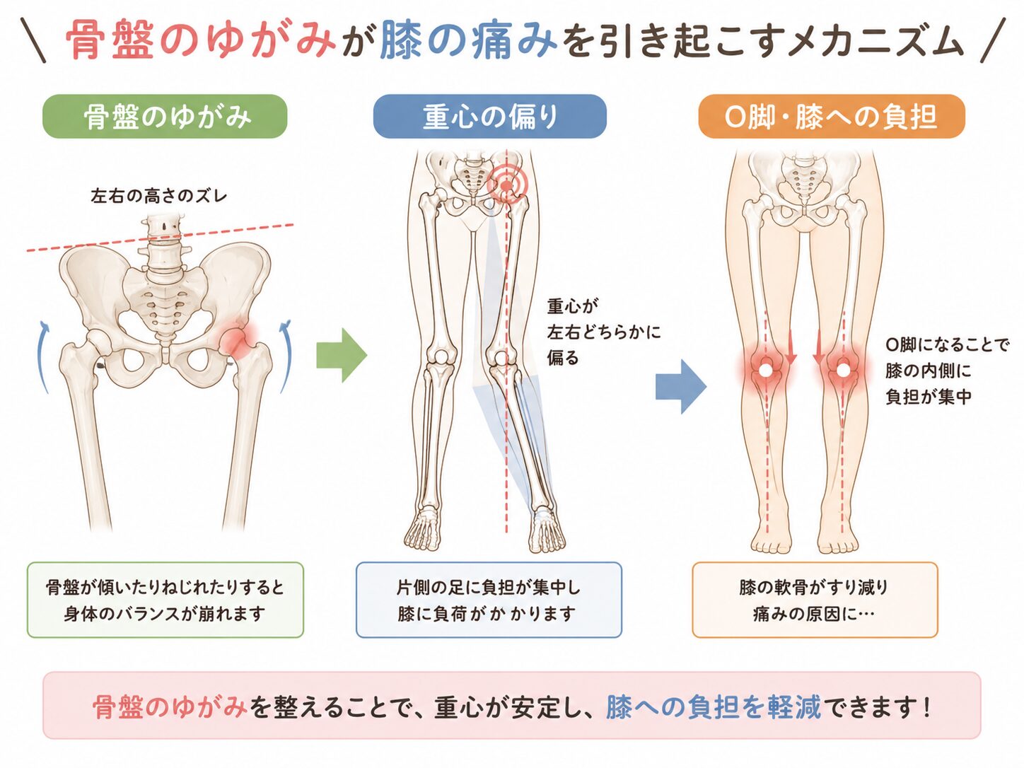 骨盤のゆがみと膝への負担の関係イメージ|東近江市